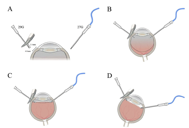 Equipment and positioning of needles for gas exchange. A: A 27-gauge needle is connected to the irrigation line of the phaco machine and then inserted through the pars plana 4.0mmposterior to the limbus in the inferotemporal quadrant. When the tip is visualized through the pupil, the infusion is switched on. Next, the 29-gauge needle is clamped 2.5 mm from the tip using curved artery forceps and passed through the pars plana in the superonasal quadrant to allow gas to escape. B: The position of needles within the eye prior to fluid–gas exchange. C: Fluid–gas exchange is performed with the eye level until the fluid level reaches the tip of the 29-gauge needle. During this time, the rising fluid level can be seen through the pupil as visible changes in the microscope light reflex. D: The eye is rotated inferotemporally to place the 29-gauge needle uppermost and direct the residual gas bubble toward the tip of the needle, ensuring that the maximum possible amount of gas is exchanged.